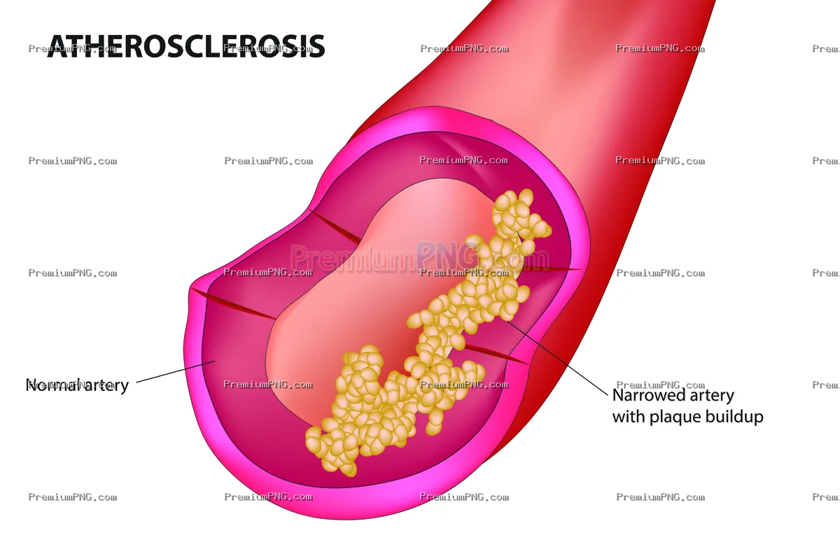 Atherosclerosis Vector EPS – Artery Plaque Medical Vector Illustration