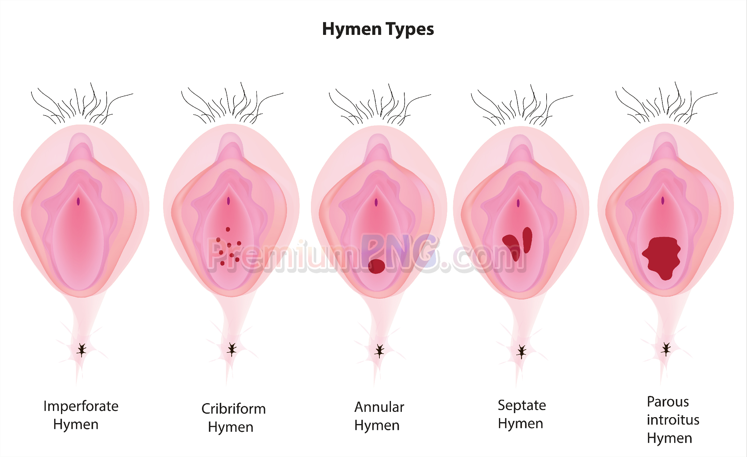 Hymen Types Medical Vector Set | Anatomical Diagrams (EPS, SVG, PNG)