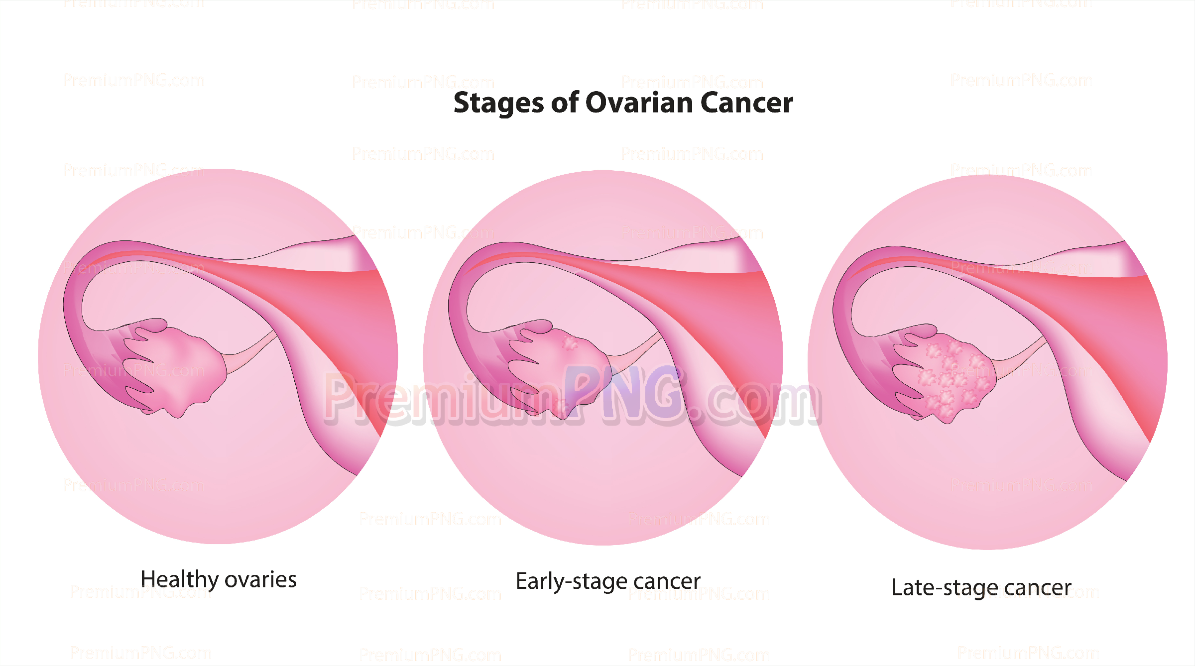 Stages of Ovarian Cancer
