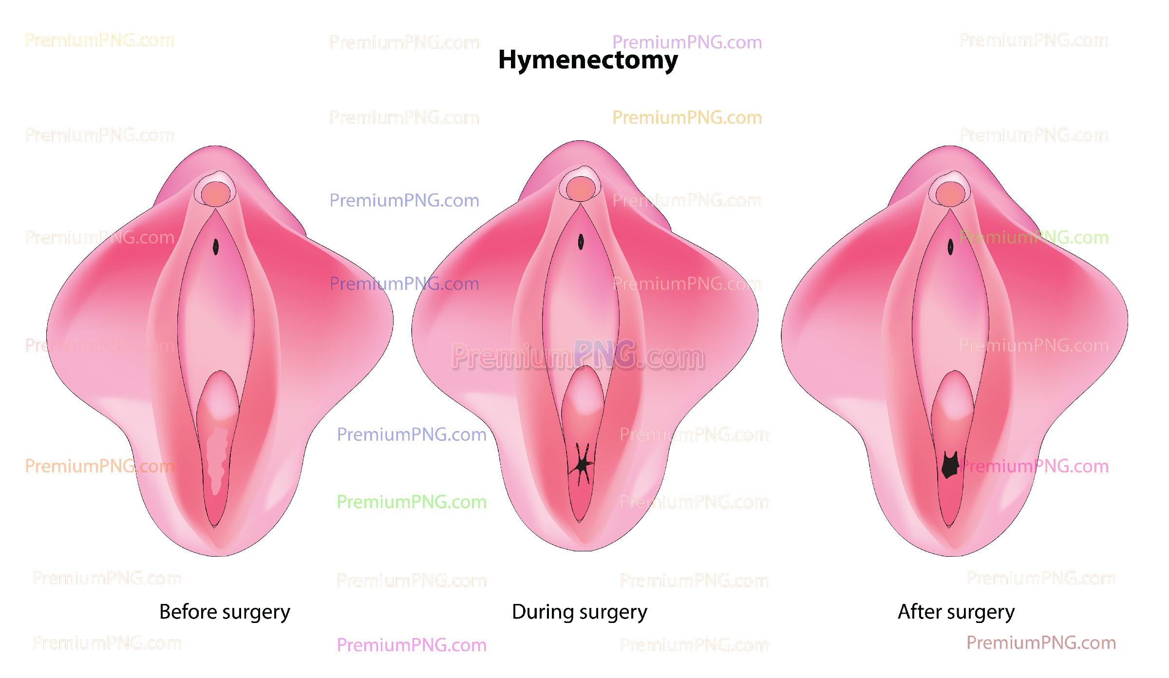 Hymenectomy medical vector