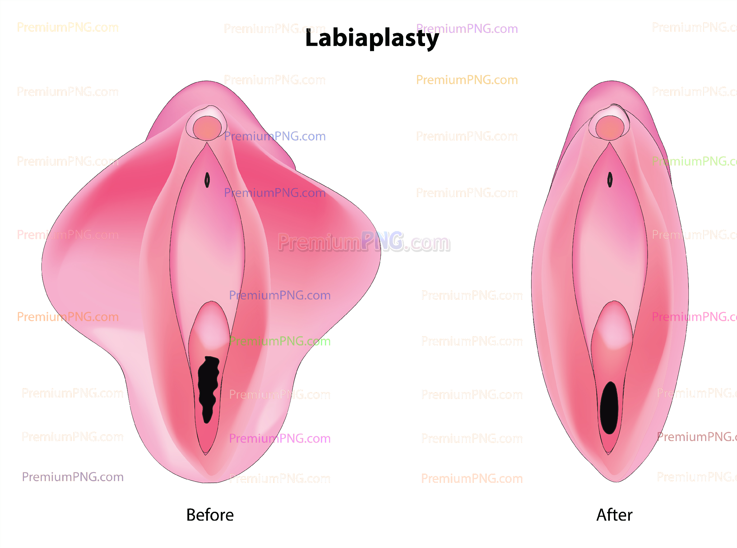 Labiaplasty vector