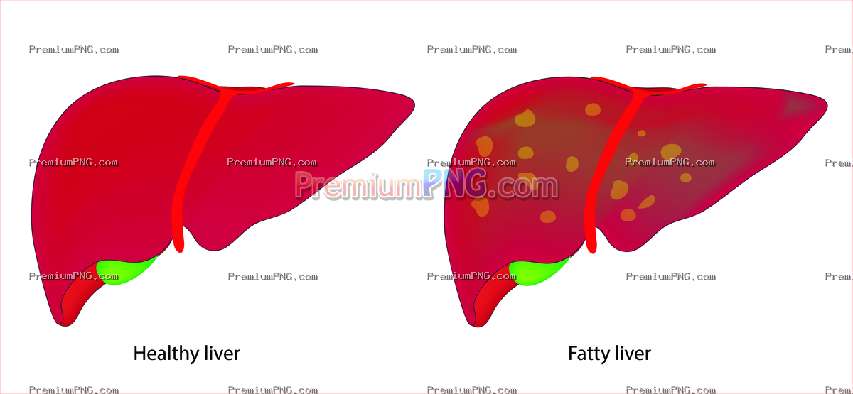 Fatty Liver Disease Medical Illustration EPS | Liver Health, Anatomy & Hepatic Steatosis Vector
